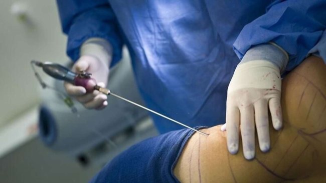 Liposaksiya əməliyyatı etdirən modelin bədəni çürüyür, həkim isə iddiaları qəbul etmir:“Pulunu da qaytarmışam”